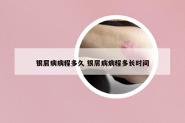 銀屑病病程多久 銀屑病病程多長時間