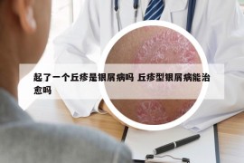 起了一個丘疹是銀屑病嗎 丘疹型銀屑病能治愈嗎