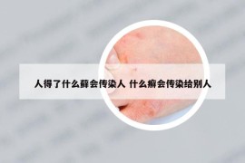 人得了什么蘚會(huì)傳染人 什么癬會(huì)傳染給別人