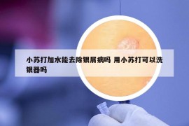小蘇打加水能去除銀屑病嗎 用小蘇打可以洗銀器嗎
