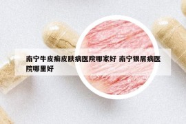 南寧牛皮癬皮膚病醫(yī)院哪家好 南寧銀屑病醫(yī)院哪里好