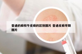 普通的癬和牛皮癬的區(qū)別圖片 普通皮癬早期圖片