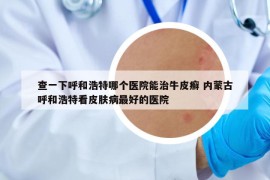 查一下呼和浩特哪個醫(yī)院能治牛皮癬 內(nèi)蒙古呼和浩特看皮膚病最好的醫(yī)院
