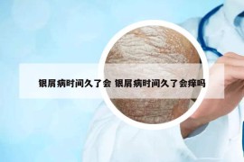 銀屑病時(shí)間久了會(huì) 銀屑病時(shí)間久了會(huì)癢嗎
