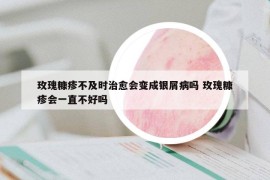 玫瑰糠疹不及時(shí)治愈會(huì)變成銀屑病嗎 玫瑰糠疹會(huì)一直不好嗎