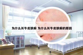 為什么長(zhǎng)牛皮膚癬 為什么長(zhǎng)牛皮膚癬的原因