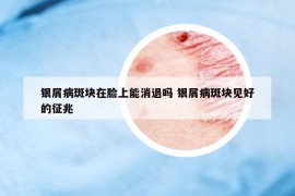 銀屑病斑塊在臉上能消退嗎 銀屑病斑塊見好的征兆