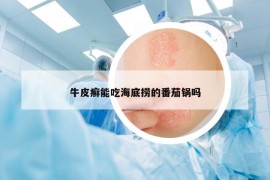 牛皮癬能吃海底撈的番茄鍋嗎