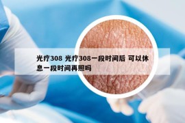 光療308 光療308一段時(shí)間后 可以休息一段時(shí)間再照嗎
