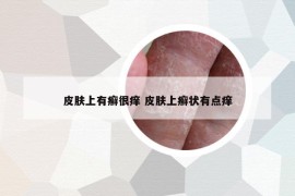 皮膚上有癬很癢 皮膚上癬狀有點(diǎn)癢