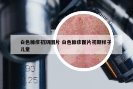 白色糠疹初期圖片 白色糠疹圖片初期樣子 兒童