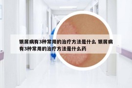 銀屑病有3種常用的治療方法是什么 銀屑病有3種常用的治療方法是什么藥
