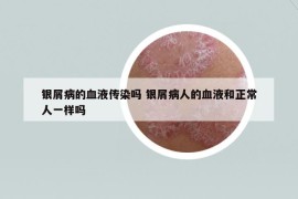 銀屑病的血液傳染嗎 銀屑病人的血液和正常人一樣嗎