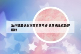 治療銀屑病北京那家醫(yī)院好 銀屑病北京最好醫(yī)院