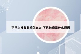 下巴上反復(fù)長(zhǎng)癬怎么辦 下巴長(zhǎng)癬是什么原因