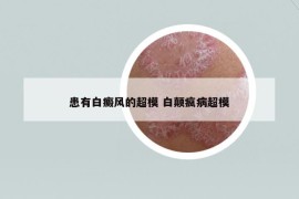 患有白癜風(fēng)的超模 白顛瘋病超模