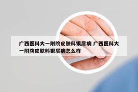 廣西醫(yī)科大一附院皮膚科銀屑病 廣西醫(yī)科大一附院皮膚科銀屑病怎么樣