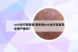 uvb光療銀屑病 銀屑病uvb光療后復發(fā)會更嚴重嗎?