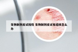 生物制劑皮試陽性 生物制劑皮試有結(jié)核怎么辦