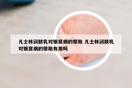 凡士林潤膚乳對銀屑病的幫助 凡士林潤膚乳對銀屑病的幫助有用嗎