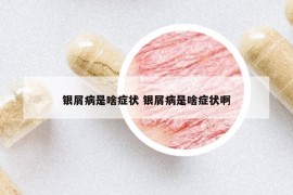 銀屑病是啥癥狀 銀屑病是啥癥狀啊