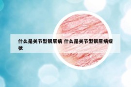 什么是關(guān)節(jié)型銀屑病 什么是關(guān)節(jié)型銀屑病癥狀