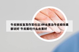 牛皮鮮反復(fù)發(fā)作常吃這3種水果治牛皮癬效果都說(shuō)好 牛皮廨吃什么水果好