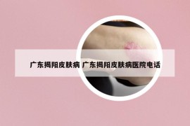 廣東揭陽皮膚病 廣東揭陽皮膚病醫(yī)院電話