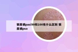 銀屑病pasi90和100有什么區(qū)別 銀屑病pso