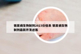 銀屑病生物制劑2023價格表 銀屑病生物制劑最新開發(fā)進展