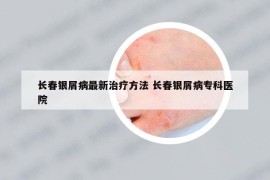 長春銀屑病最新治療方法 長春銀屑病?？漆t(yī)院