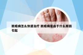 膿皰病怎么快速治療 膿皰病是由于什么原因引起