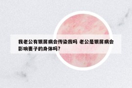 我老公有銀屑病會(huì)傳染我嗎 老公是銀屑病會(huì)影響妻子的身體嗎?