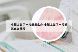 小腿上出了一片癬怎么辦 小腿上出了一片癬怎么辦圖片