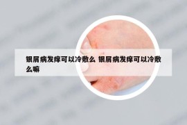 銀屑病發(fā)癢可以冷敷么 銀屑病發(fā)癢可以冷敷么嘛