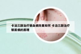 卡泊三醇治療銀血病效果如何 卡泊三醇治療銀屑病的原理