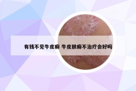 有錢(qián)不見(jiàn)牛皮癬 牛皮膚癬不治療會(huì)好嗎