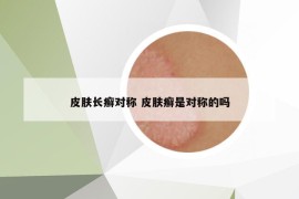 皮膚長癬對稱 皮膚癬是對稱的嗎