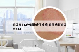 維生素b12針劑治療牛皮癬 銀屑病打維生素b12