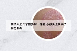 孩子頭上長了很多癬一樣的 小孩頭上長滿了癬怎么辦