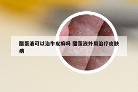 醋蛋液可以治牛皮癬嗎 醋蛋液外用治療皮膚病