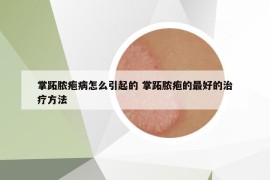 掌跖膿皰病怎么引起的 掌跖膿皰的最好的治療方法