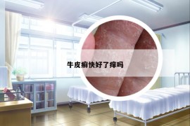 牛皮癬快好了癢嗎
