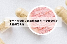 十個月寶寶得了銀屑病怎么辦 十個月寶寶身上有癬怎么辦