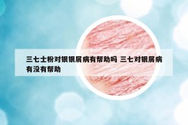 三七士粉對銀銀屑病有幫助嗎 三七對銀屑病有沒有幫助