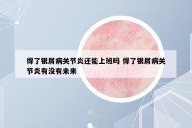 得了銀屑病關(guān)節(jié)炎還能上班嗎 得了銀屑病關(guān)節(jié)炎有沒(méi)有未來(lái)