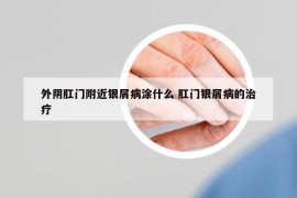 外陰肛門附近銀屑病涂什么 肛門銀屑病的治療
