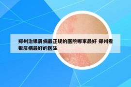 鄭州治銀屑病最正規(guī)的醫(yī)院哪家最好 鄭州看銀屑病最好的醫(yī)生