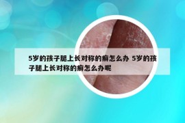 5歲的孩子腿上長對稱的癬怎么辦 5歲的孩子腿上長對稱的癬怎么辦呢