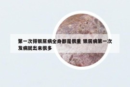 第一次得銀屑病全身都是很重 銀屑病第一次發(fā)病就出來很多